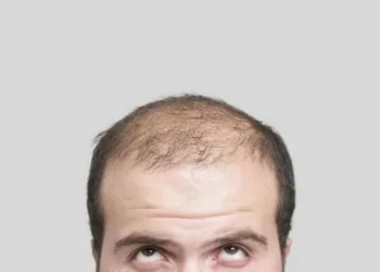 Teste ajuda a detectar predisposição à calvície a partir de amostra de saliva